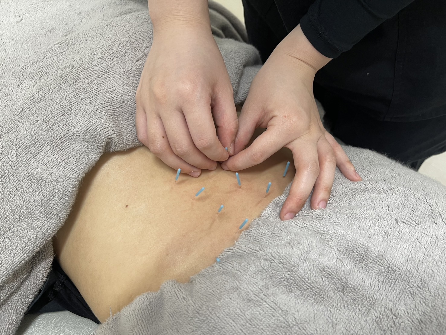 うつぶせで腰に鍼治療をうける女性