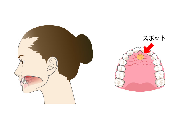 舌の位置を整える体操